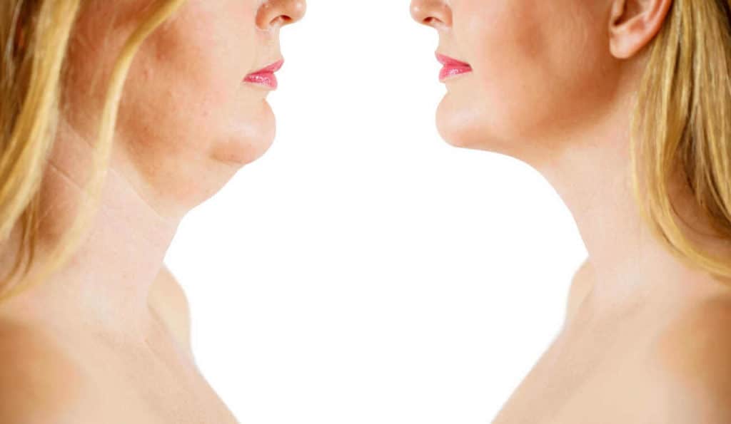 Double Chin treatment Reigate before and after results
