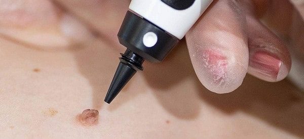 After Skin Tag Removal Reigate