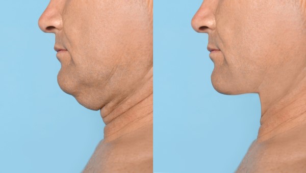 Which Non-Surgical Treatments Work Best for Jowls and Loose Skin Reigate?
