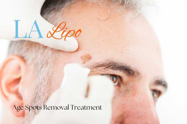 What Are the Most Effective Treatments for Age Spots Reigate?