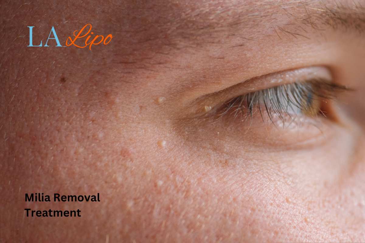Cryopen Milia Removal: Is It the Easiest and Safest Option Reigate?