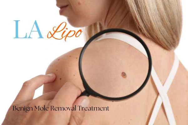 Woman having her inspection of blemish before mole removal Reigate