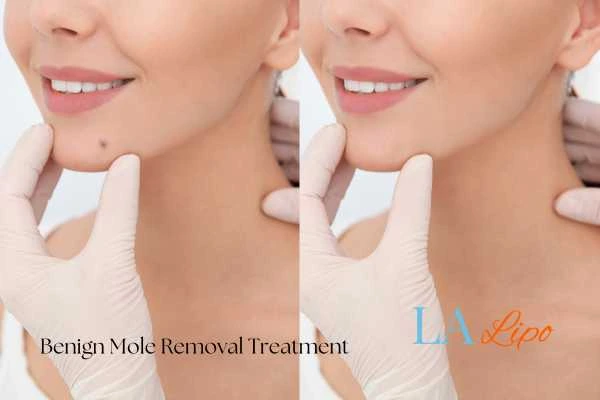 Before and after mole removal Reigate treatment