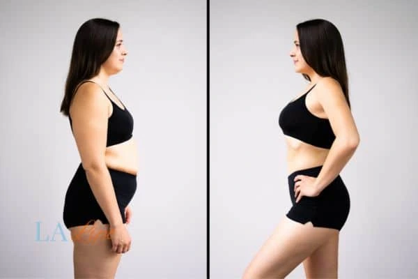 image of woman before and after results of LA-EMS Body Sculpting Reigate to help treat Diastasis recti