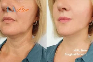 hi-fu for wrinkles Reigate before and after results