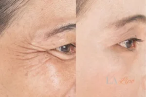 Before and after results of woman - HI-fu wrinkles reduction treatment Reigate