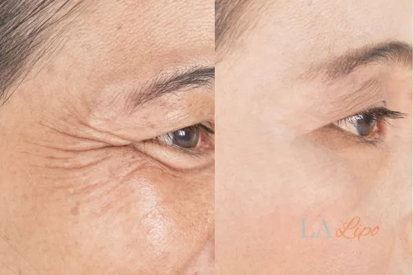 Before and after results of woman - HI-fu wrinkles reduction treatment Reigate