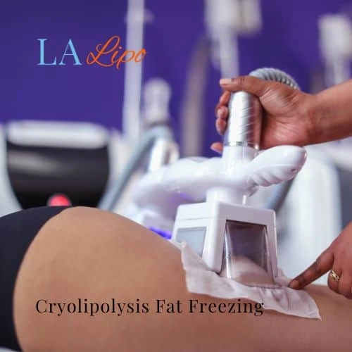fat freezing - Cryolipolysis Reigate