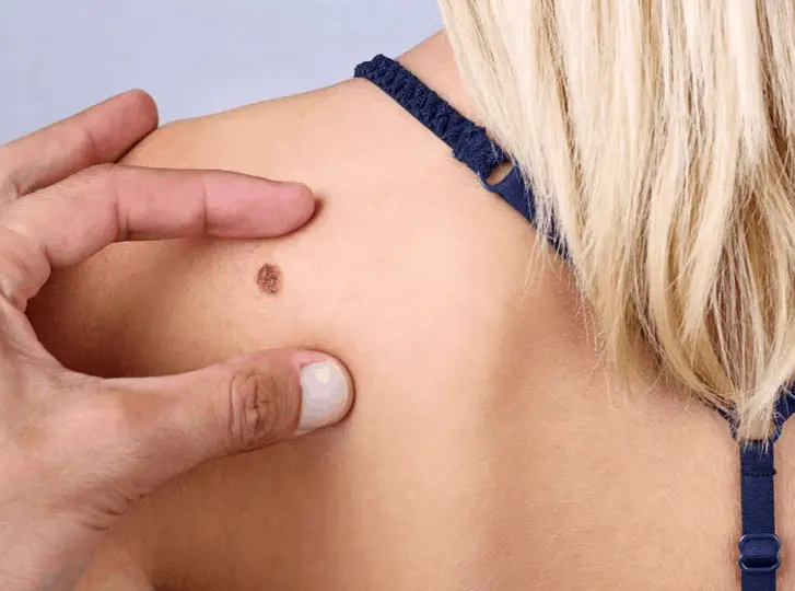 woman having mole removal Reigate consultation before treatment.