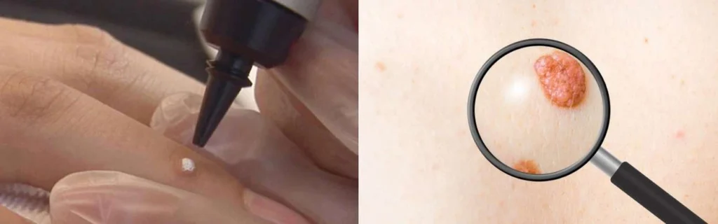 CryoPen practitioner Reigate assessing a benign mole before treatment