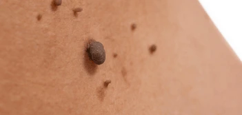 image of a skin tag Reigate