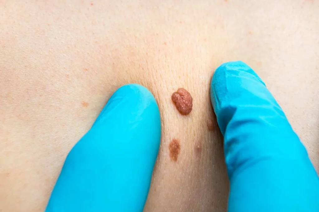 Consultant examining a skin tag Reigate