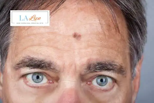 Solar Lentigo Removal Reigate image of man with mark on his forehead