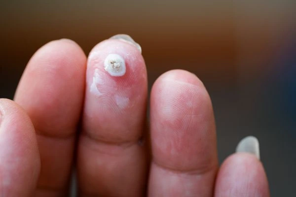 wart on person finger - cryotherapy to treat from LA LIPO Reigate