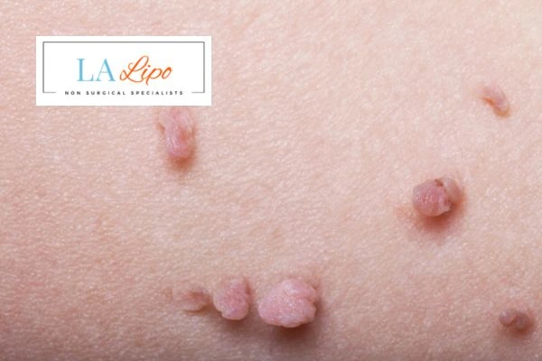 Does cryopen skin tag removal Reigate hurt? Find out now call our team today!