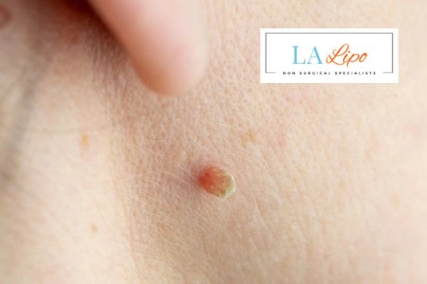 Book skin tag removal Reigate today speak to our team now!