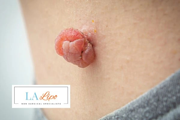 Interested in skin tag removal Reigate? Concerned about the pain? Find out more today!