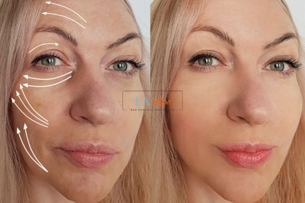Morpheus 8 results Reigate face lift.