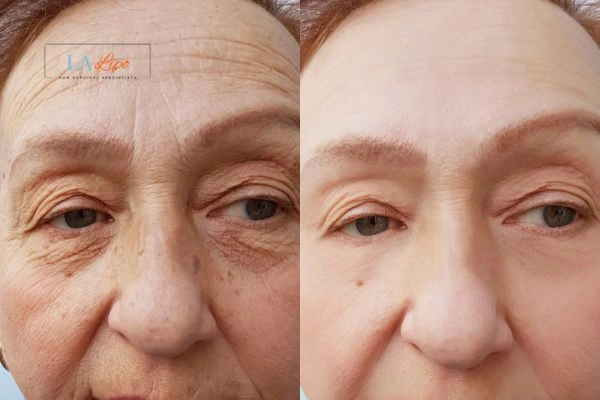 The powerful benefits of Morpheus8 Treatment Reigate - Call Our team today!