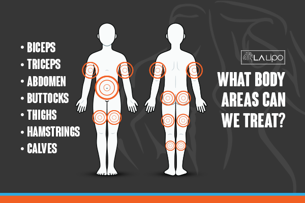 Diagram to show areas you can have LA-EMS Body Sculpting Treatment Reigate