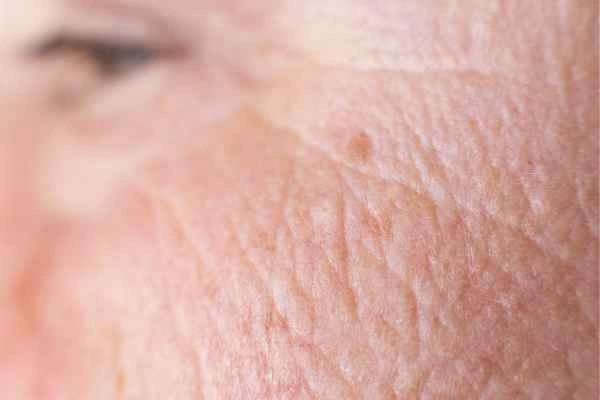 close up picture of a woman's face showing an age spot Reigate