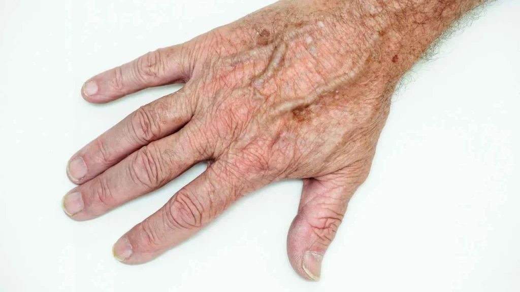 Male hand showing age spot Reigate