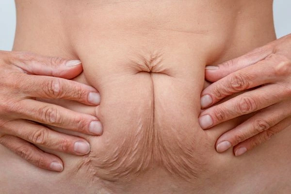 Should I Combine Diastasis Recti Treatment with Body Contouring for Better Results Reigate?