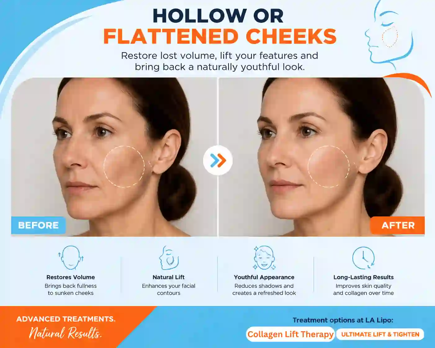 Sign #4: Hollow or Flattened Cheeks Reigate